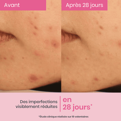 Concentrated Anti-Blemish Serum